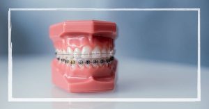 a 3D dental model showing orthodontic braces with power chain elastic connectors between brackets