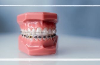 Are Power Chains The Last Step In Braces? Best Guide