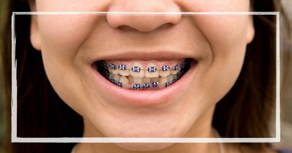a person smiling widely with metal braces featuring power chains for teeth alignment.