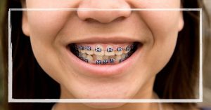 a person smiling widely with metal braces featuring power chains for teeth alignment.