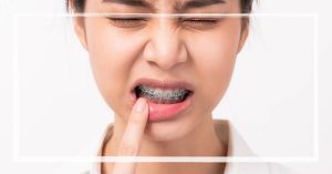4 Ways How To Relieve Braces Power Chain Pain | Guide