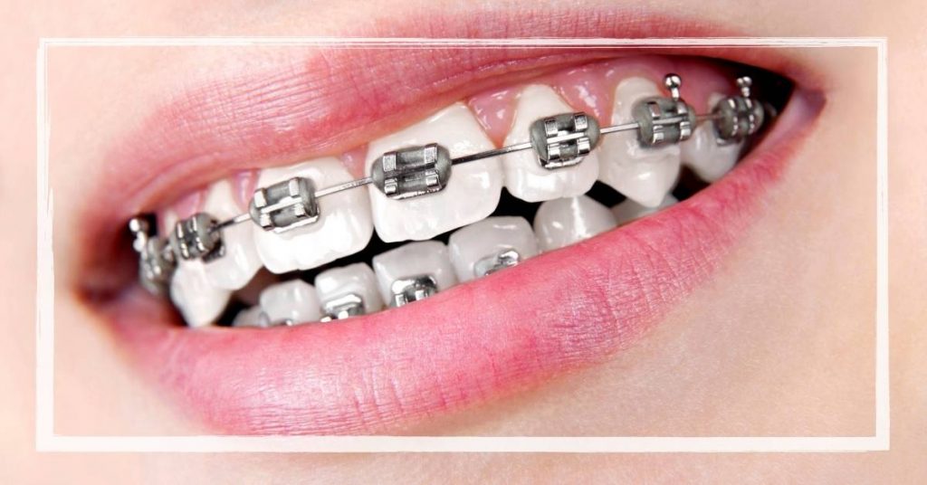 a person’s upper teeth fitted with metal orthodontic braces for teeth alignment, showcasing gap closure without power chains.