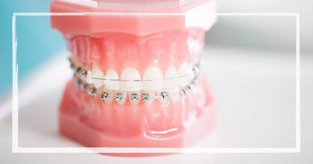 a dental model showing metal braces with power chain elastic connectors on front teeth