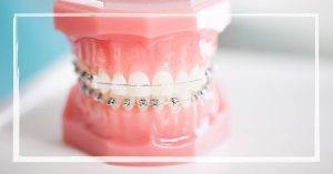 a dental model showing metal braces with power chain elastic connectors on front teeth