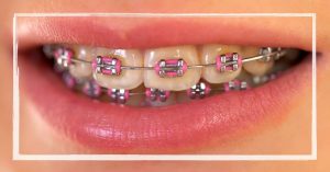 a close-up of someone’s teeth wearing stylish hot pink and silver orthodontic braces with colorful elastics