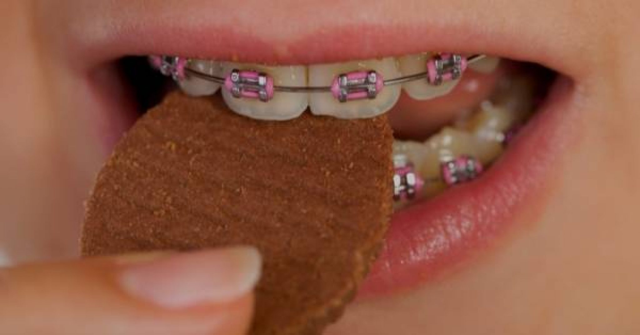 Hot Pink Braces: 10 Pros & 3 Cons! Ultimate [year] Guide!