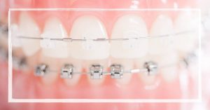a close-up of metal braces with a power chain attached, applying pressure on upper front teeth for orthodontic alignment.