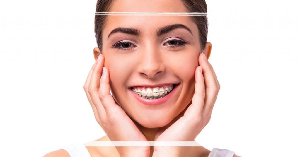 a smiling person wearing clear braces with hands supporting cheeks, highlighting improved dental alignment.
