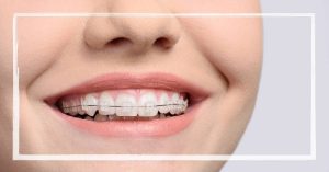 a person smiling with clear power chain braces on their teeth for orthodontic treatment
