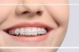 when will i get power chains braces