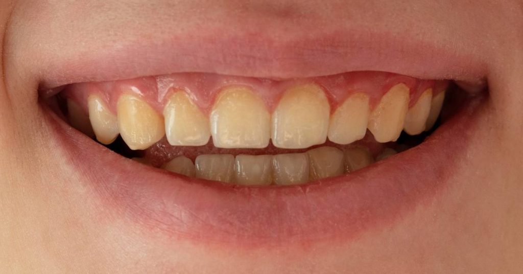 a close-up of a person’s lower and upper front teeth showing noticeable tooth discoloration and varying shades of yellowing.