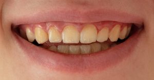 a close-up of a person’s lower and upper front teeth showing noticeable tooth discoloration and varying shades of yellowing.