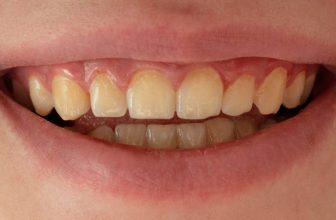Are Yellow Teeth Healthy? Prevention & Treatment | Ultimate Guide