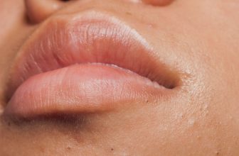 Can Someone With Braces Get Black Spots On Their Lips?