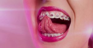 cute color braces