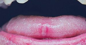 does stress cause canker sores in your mouth