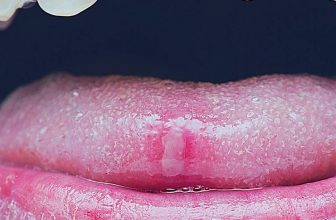 does stress cause canker sores in your mouth