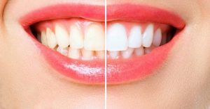 a before-and-after comparison of teeth showing natural discoloration versus professionally whitened results