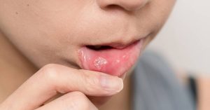 Does Alum Powder Cure Canker Sores Safely? Ultimate Guide