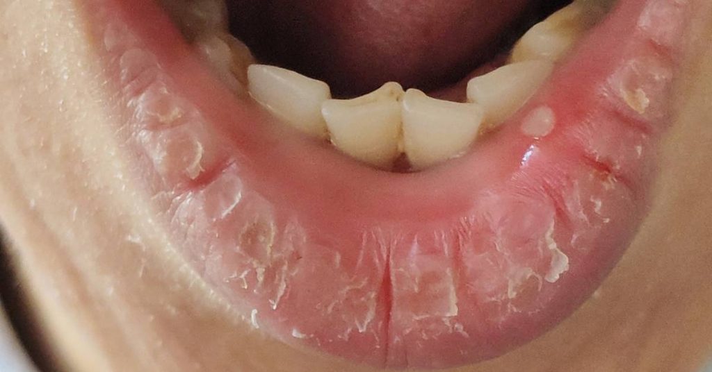 a close-up of aphthous ulcers on the inner lower lip and gum area showing red inflamed sores with white patches