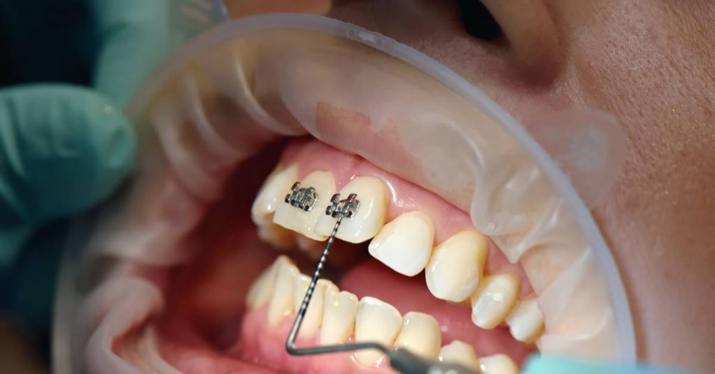 a person’s lower and upper front teeth with black metal brackets and wire during orthodontic treatment.