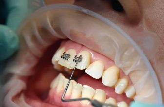 20 Reasons To Choose Black Braces Color | Ultimate Style Guide