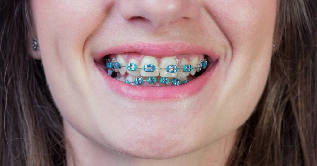 19 Reasons To Choose Blue Braces Color | Ultimate Guide