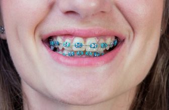 19 Reasons To Choose Blue Braces Color | Ultimate Guide