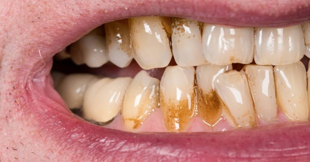 a close-up of a person’s lower and upper teeth showing significant tartar or calculus buildup on molars and adjacent gumline.