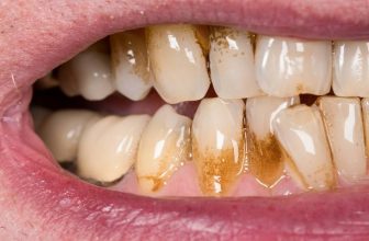 What is a Calculus Bridge? 8 Effective Removal Methods!