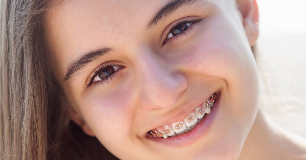 a smiling person wearing clear orthodontic braces, showing dental alignment treatment.