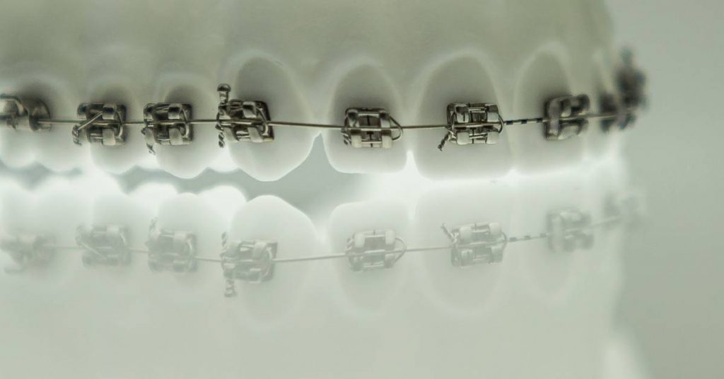 a close-up view of metal braces with clear brackets attached to slightly uneven, naturally colored teeth