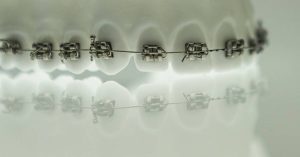 Can You Get Braces With Veneers? Ultimate Guide