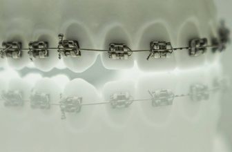 Can You Get Braces With Veneers? Ultimate Guide