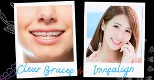 Clear Braces vs. Invisalign: 12 Main Differences | Ultimate Guide