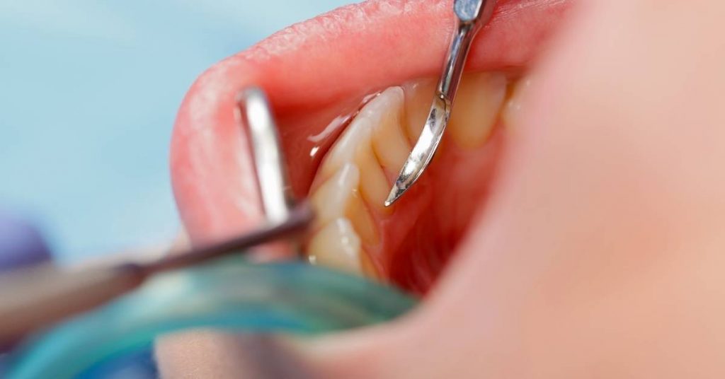 a close-up of dental tools gently lifting gum tissue to reveal supragingival calculus on teeth during oral hygiene procedure