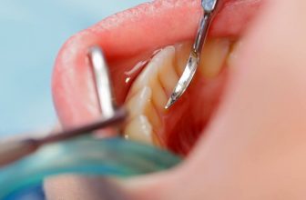 8 Easy Methods For Dental Calculus Removal At Home! Ultimate Guide