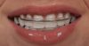 Do You Have To Wear Retainers Forever? Ultimate Guide