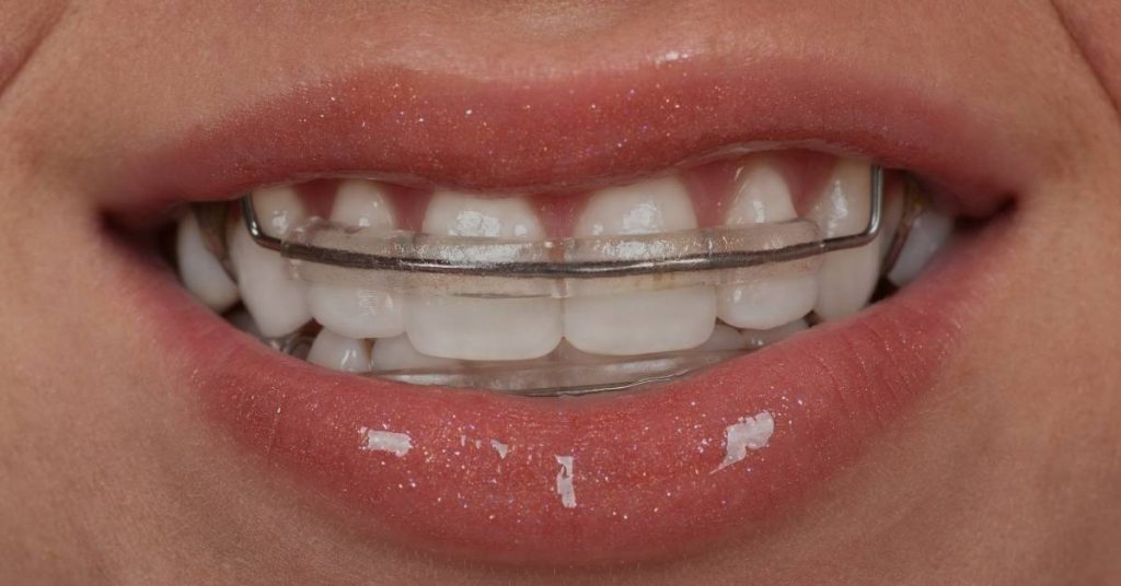 a person wearing a clear fixed orthodontic retainer on their upper teeth to retain alignment after treatment
