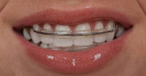 Do You Have To Wear Retainers Forever? Ultimate Guide
