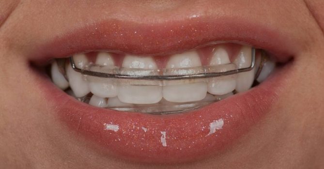 Do You Have To Wear Retainers Forever? Ultimate Guide