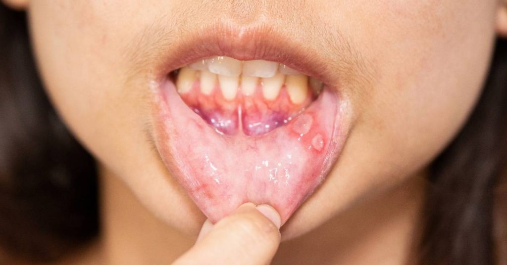 a person’s open mouth showing inflamed canker sores on the inner lower lip during examination.