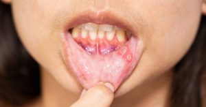 Luminance Red Reviews – Does It Cure Canker Sores? Buying Guide