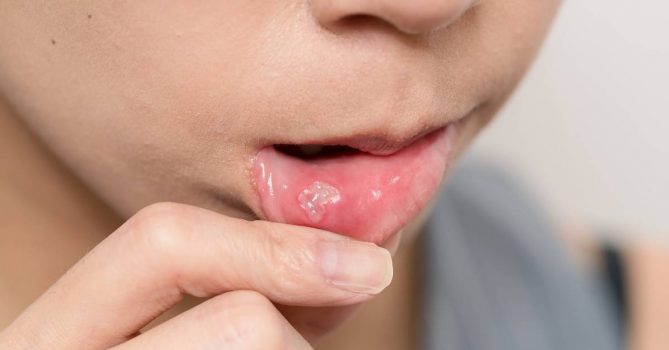 Does Mouthwash Help Canker Sores? Ultimate Buying Guide