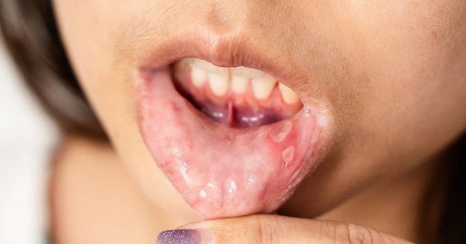 5 Ways How Does Salt Help Canker Sores Go Away! | Best Guide
