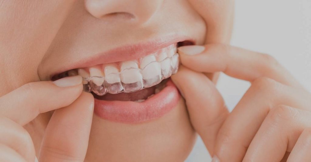 a person adjusting clear Invisalign aligners with hands holding the retainer for cleaning or placement