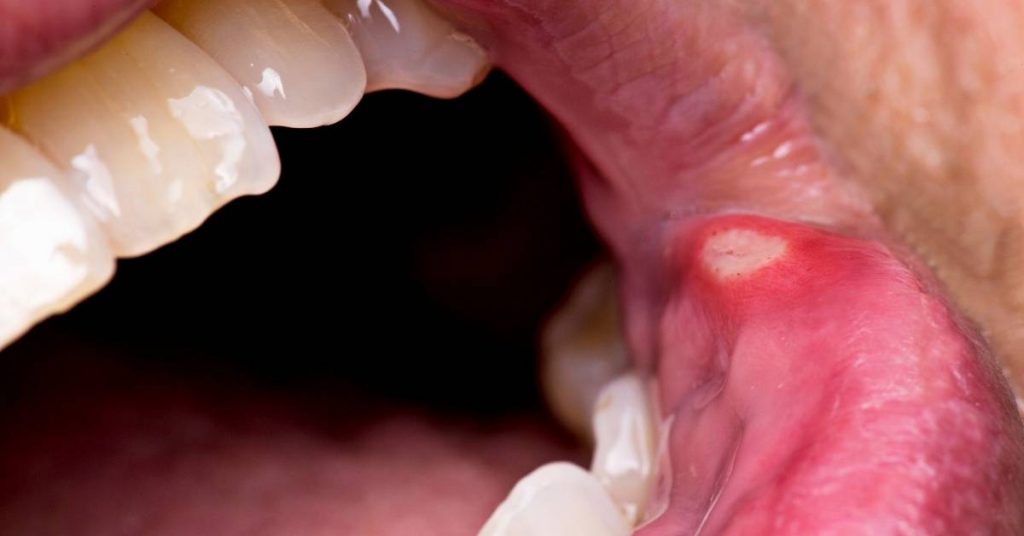 a close-up of an inflamed canker sore on the inner cheek for effective treatment and pain relief