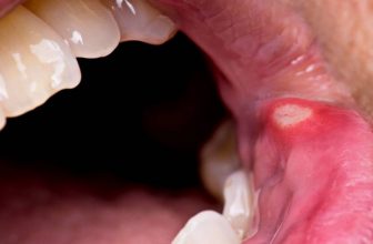 How To Get Rid Of A Canker Sore In 24 Hours | 23 Effective Treatments
