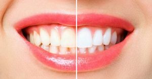 a before-and-after comparison of teeth showing natural yellowing versus brightened, whitened results after treatment.