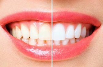 18 Ways To Get Rid Of Yellow Teeth Naturally At Home! Ultimate Guide